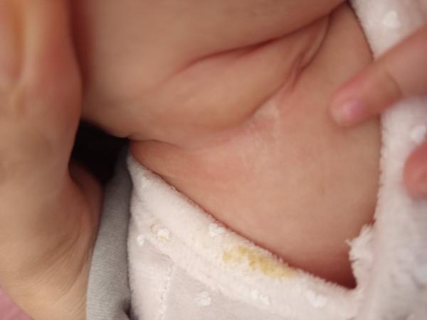 Uzavřená vkleslina na krku. Čím ošetřit, když z toho teče zelený hnis?