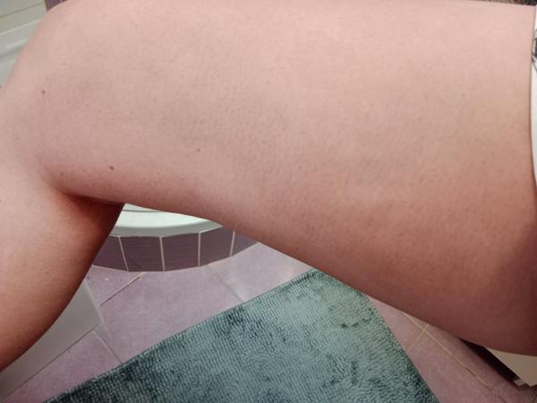 Záhadné modré fleky na těle. Jak na ně reagovat?