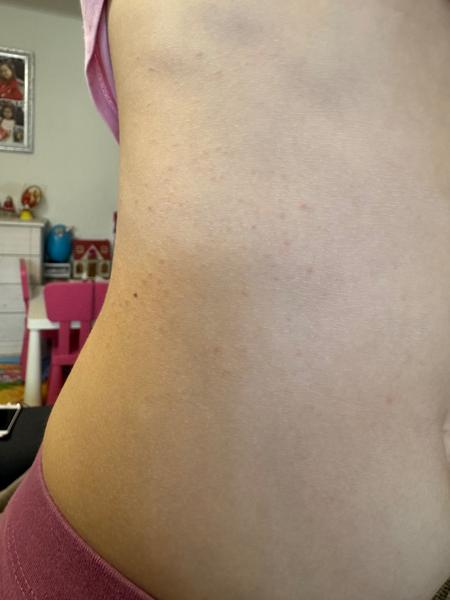 Jak zjistit, zda je vyrážka alergií nebo něčím jiným?