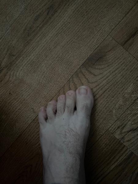 Jak řešit zarostlý nehet? Rady a zkušenosti ze Slovenska