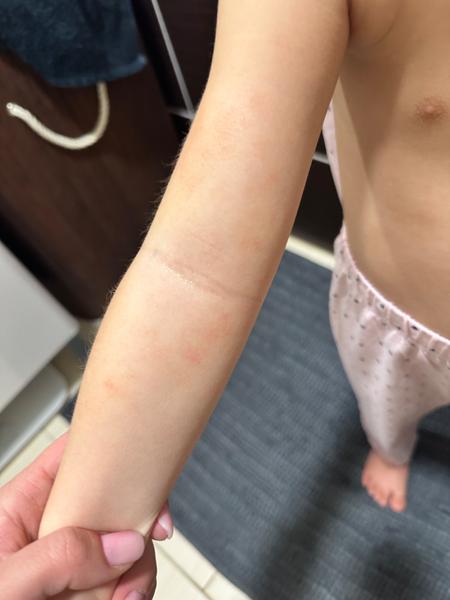 Vyrážka a teploty bez příznaků: Jaká nemoc by to mohla být?