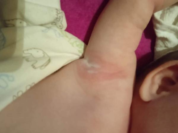 Je to zapařka? Rady pro podráždění v podpaží u dětí