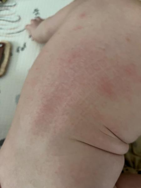 Možné příčiny vyrážky u kojence? Zkušenosti rodičů