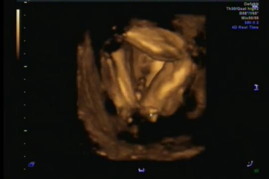 Holka nebo kluk? Matoucí výsledky ultrazvuku ve 26. týdnu