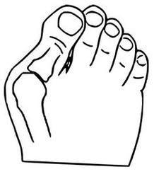 Hallux valgus - vybočený palec