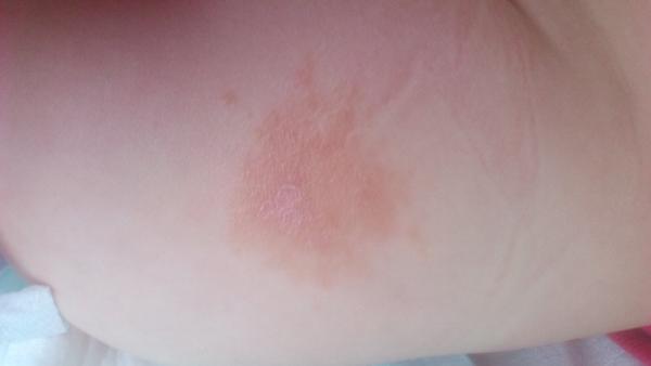 Ekzém? Čím mazat?