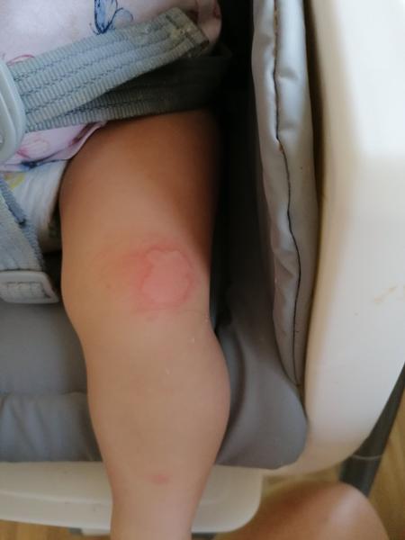 Kopřivka. Máte zkušenost?