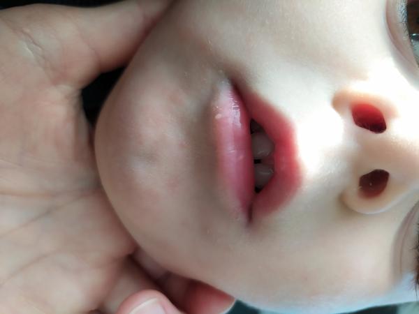 Výrůstek na rtu. Co to je?