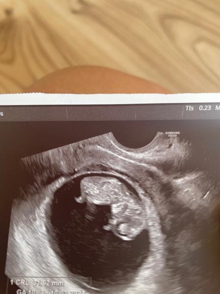 Jak odhadnout pohlaví dítěte z fotek ultrazvuku?