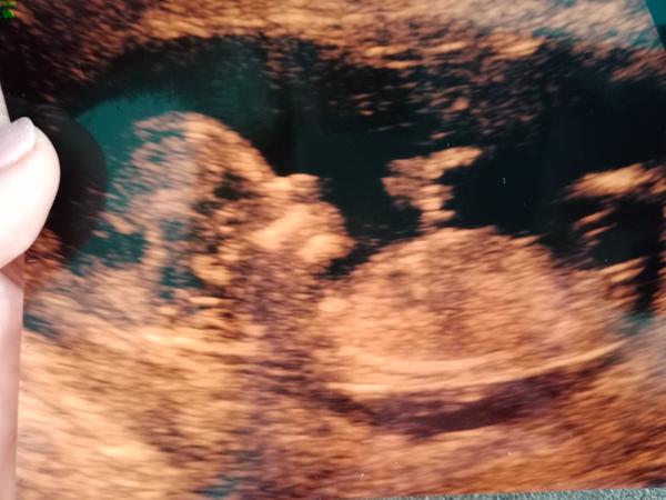 Jak rozpoznat pohlaví pomocí hrbolku?