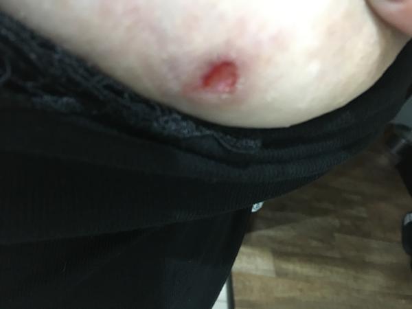 Otevřená ranka na prsu. Z čeho to může být?