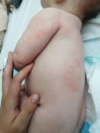 Kvasinka nebo atopický ekzém? Jak léčit?