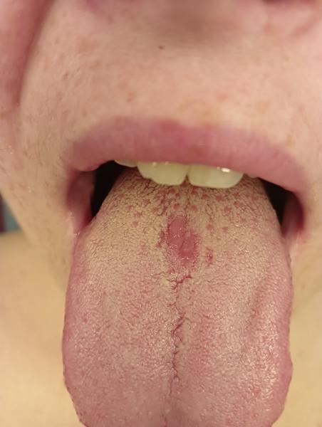 Co způsobuje problémy na jazyku při kojení? 