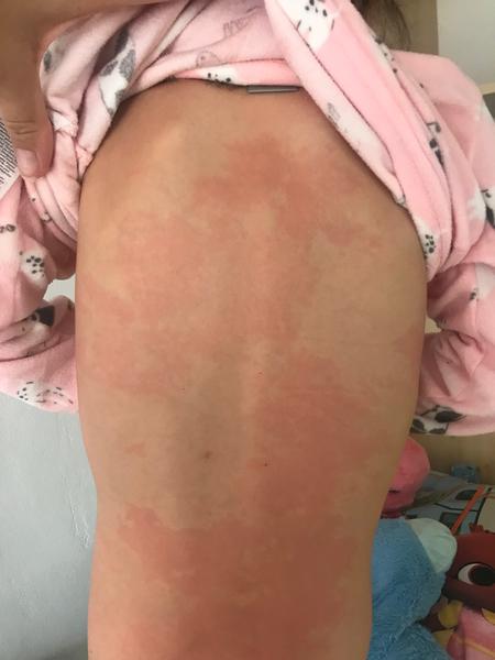 Co způsobuje červené mapky na těle dítěte?