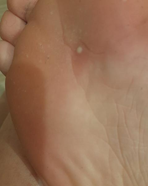 Co způsobuje bolestivý bolák na noze?