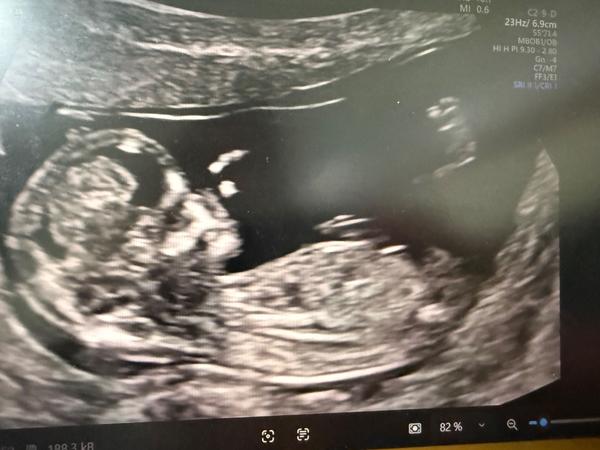 Pohlaví podle screeningu ve 12. týdnu. Co myslíte?