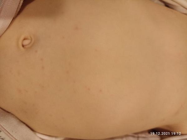 Co způsobuje vyrážku po použití mastičky Lipobase?