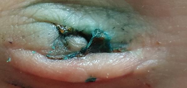 Zapomenutý steh po operaci pupeční kýly: Vaše zkušenosti?