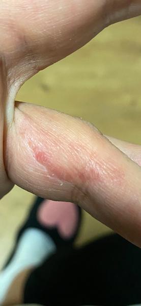 Něco na ruce, svědí a bolí to. Co by to mohlo být?