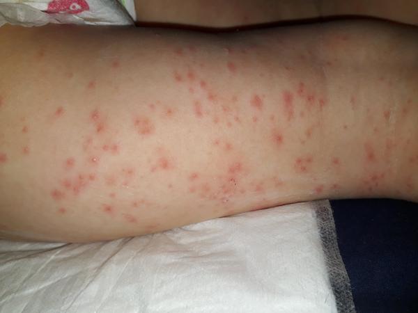 Syn je 5. den osypaný. Je to atopák nebo některá číselná nemoc?