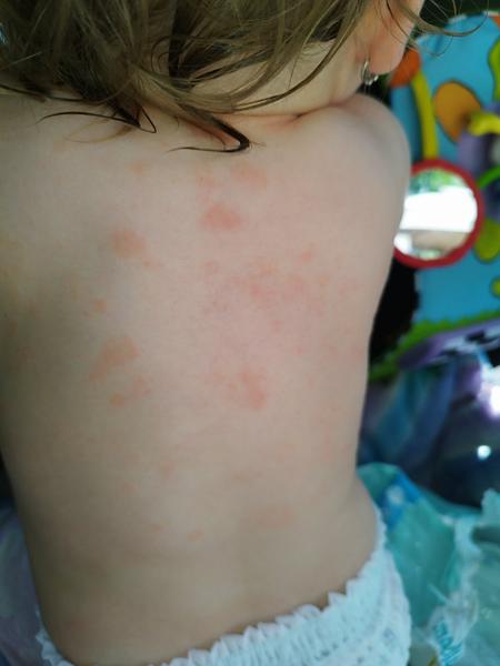 Vyrážka, oranžové flíčky, 1 rok. Může to být množštvím bílkovin?