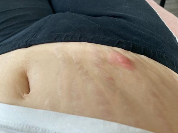 Bulka ve strii: Jak řešit zánět a bolest?