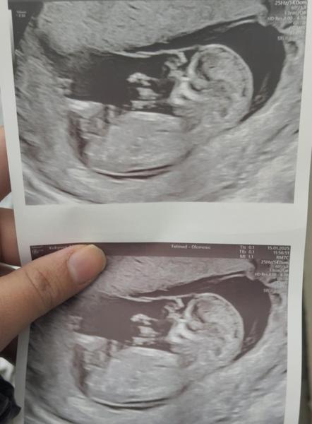 Budou na ultrazvuku vidět pohlaví v 16. týdnu?