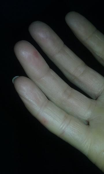 Bolestivé a svědivé prsty: Co způsobuje vyrážku?