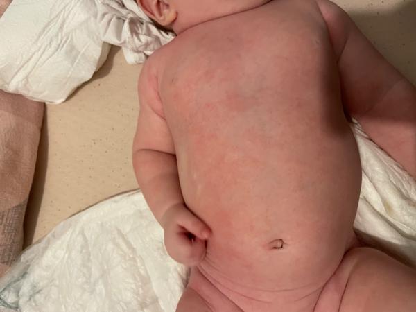 Ekzém nebo kvasinka?