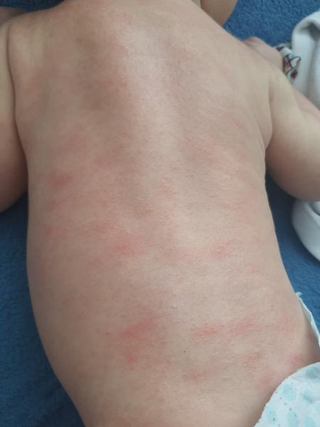 Vyrážka - malé miminko. Mátě zkušenost? Co pomohlo?