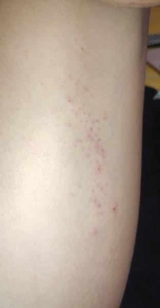 Zahadna vyrážka/ štipance