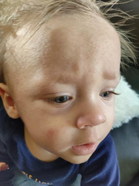 Pupínky od 4. měsíce. Co to může být?