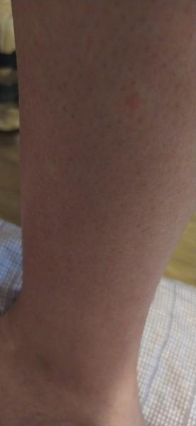 Je svědivý pupínek na noze příznakem něčeho vážného?