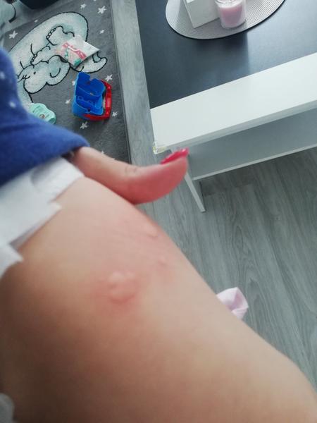 Alergie u dětí: Příznaky a řešení zkušeností rodičů