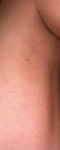 Co jsou červené pupínky na nohou?