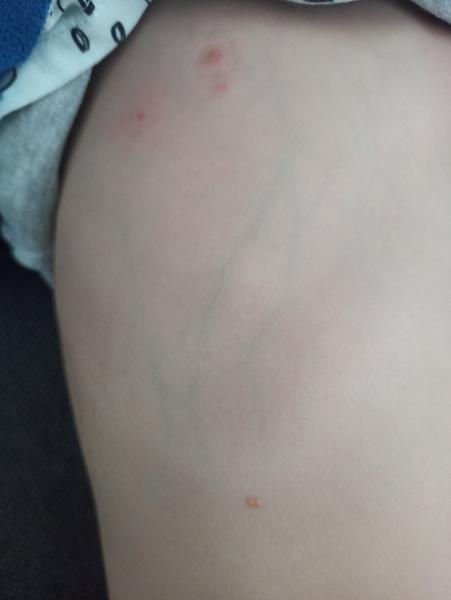 Léčba neštovic u dětí: Který gel použít?