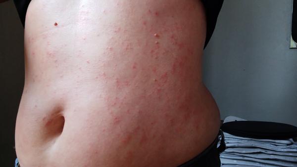 Co dělat při svědivé vyrážce před vyšetřením na alergologii?