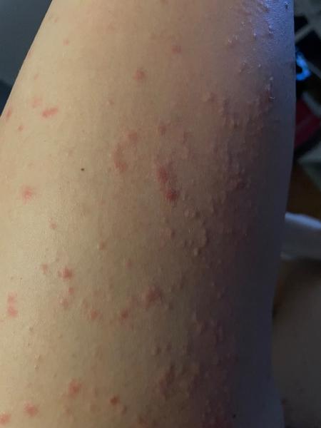 Je vyrážka opravdu lupénka, nebo může jít o něco jiného?