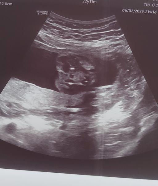 Jak zjistit pohlaví z ultrazvuku ve 21. týdnu?