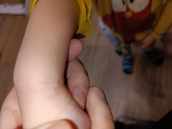 Možná opožděná reakce na Ospamox? Jak na pupínky reagovat?