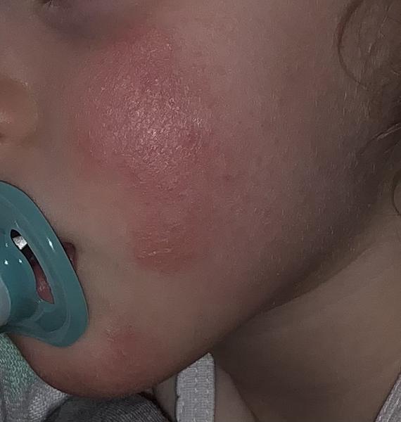 Ekzém na tvářích. Co může být příčinou? Čím mazat a umývat?