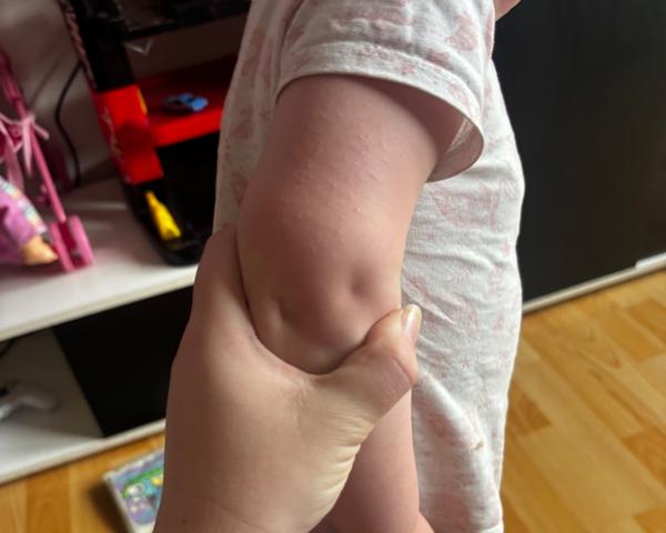 Co způsobuje svědící vyrážku u dvouleté dcery?