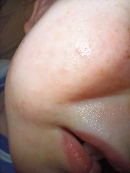 Vyrážka u dítěte. Setkal se s tím někdo?