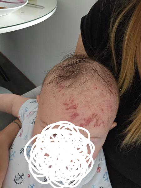 Jak zmírnit svědění a škrábání u kojence s ekzémem?