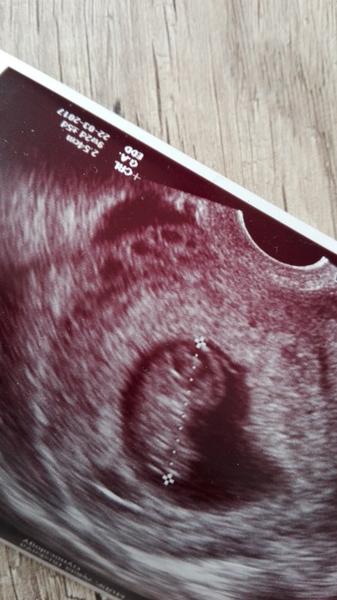 Co vidíte na ultrazvuku?