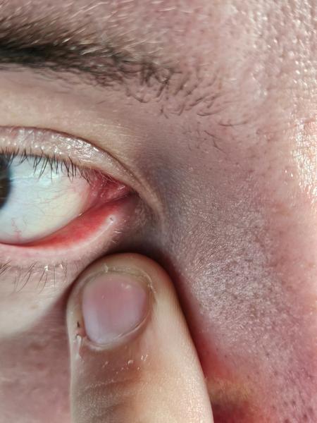 Bolestivé tečky v oku. Co to může být?