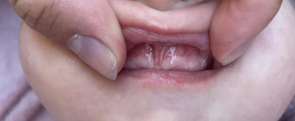 Oteklé dásně při prořezávání zubů u dětí?