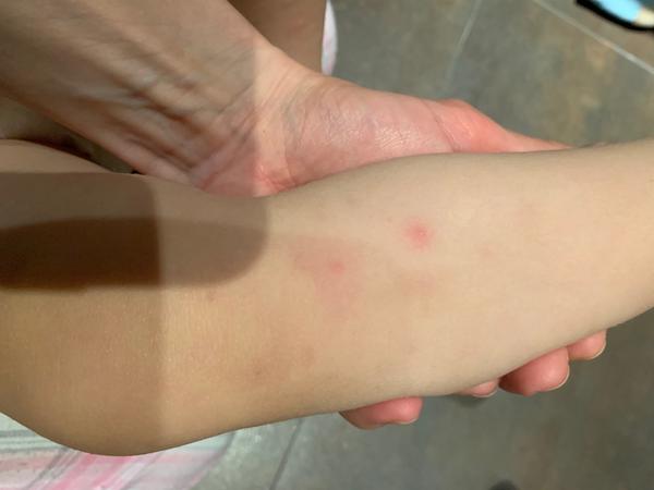 Vyrážka. Na co dalšího se zaměřit?