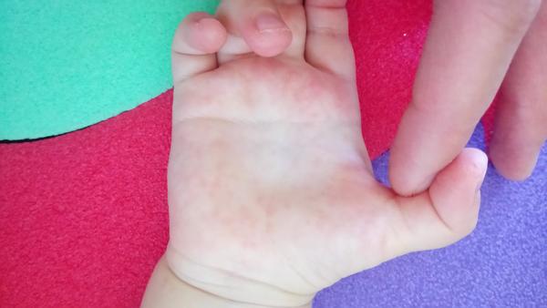 Vyrážka - trvá už skoro měsíc. Je to nakažlivé?