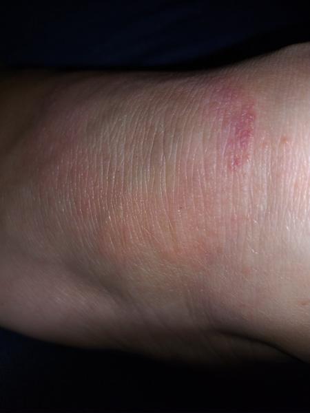 Červený flek na nártu. Borelióza, mykóza nebo něco jiného?